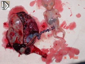 Dead Fetus from Ectopic Pregnancy