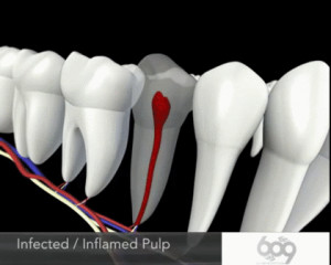 Root canal animation