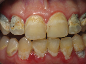 Below Are Two Severe Cases Periodontal Gum Disease Along With Many