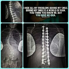 scoliosis #spinalfusion More