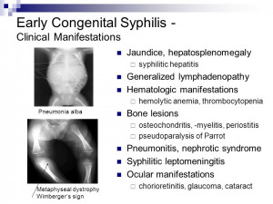 Congenital Syphilis Teeth