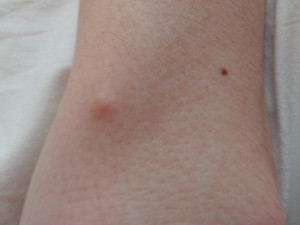 Marble Size Lump Under Skin...