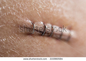 wound from appendicitis removal surgery on body - stock photo