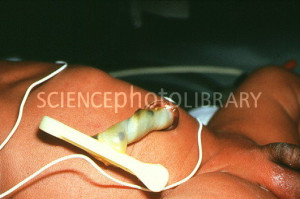 Newly cut umbilical cord of newborn baby