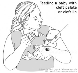 Feeding your baby aftercleft lip or cleft palate repair