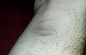 Mysterious Bruises, Self-Moving Utensils Evidence of Poltergeist ...