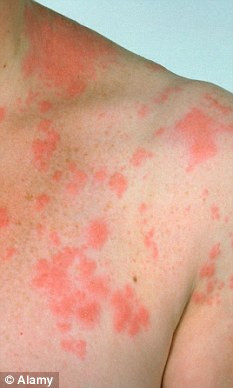 ... shingles catch shingles cause shingles chicken from chicken shingles