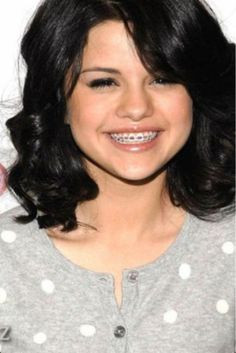 Selena Gomez with braces More