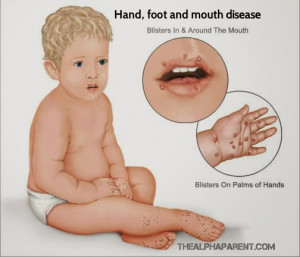 Legionnaires Disease Three