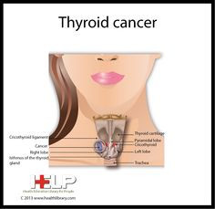 thyroid cancer more cancer medicine cancer 101 thyriod cancer thyroid ...