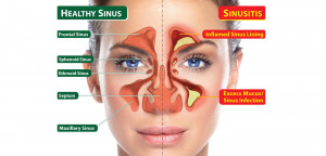 Sinus-Infection-Home-Remedies-Featured.jpg