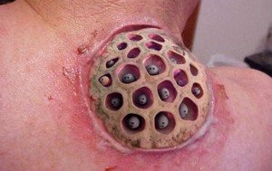 ... Effects of Head and Shoulders Worse Than the One on Your Facebook Wall