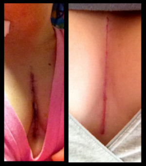 left scar 48 hours post surgery right scar 6 weeks post surgery