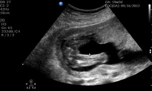 19 Week Ultrasound Boy or Girl