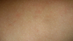 Verwandte Suchanfragen Zu Rote Flecken Am Arm Und Bein