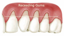 The symptoms of gingivitis recession are: