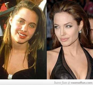 Angelina Jolie Before And After Plastic Surgery