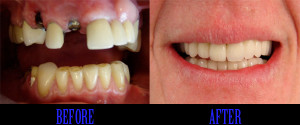 Smile Gallery Full Mouth Rehabilitation with Dental Implants