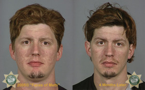 Horrifying Before and After Photos of Meth Users