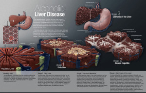 Alcoholic Liver Disease Print Illustration, Magazine spread