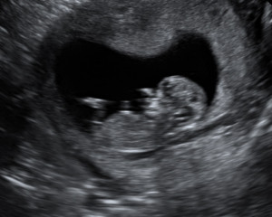 12 Week Ultrasound Boy or Girl