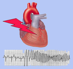 figure irregularities of the heart rhythm can occur in heart