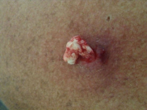 Popping Boils On Skin