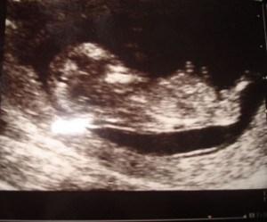 Baby at 17 Weeks Pregnant