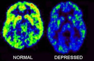 versus Depressed brain activity which is in green/yellow. Depression ...
