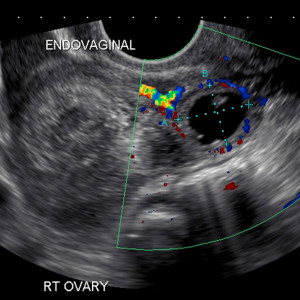 Ectopic pregnancy . Case 2