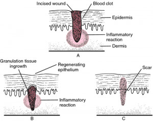 Types of Wound Healing Intention