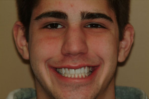 Hockey Player Missing Teeth