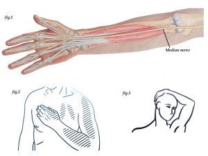 ... Carpal Tunnel Syndrome and offers some advice on how to manage its