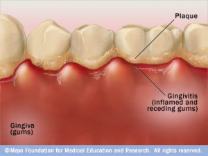 Image taken from http://www.mayoclinic.com/health/medical/IM01745