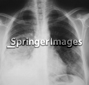 Typical radiographic characteristics of acute lobar pneumonia in a 53