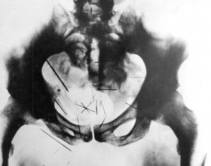 Albert Fish X-Ray - Albert Fish, serial killer & cannibal: Inside the ...