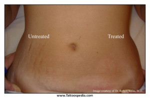... %20With%20Stretch%20Marks%202 Tattoos For Women With Stretch Marks 2