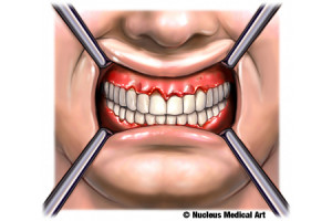 gum disease or periodontal disease is an infection of the