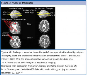 Vascular Dementia MRI