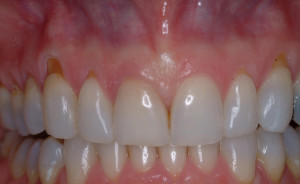 Patient-H-Before-With-Periodontal-Disease-and-Gum-Recession.jpg