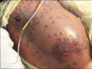 Small Pox: Complications, Diagnosis, Treatment And Absolute Prevention