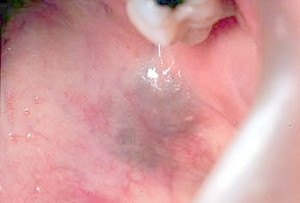 Lesion of Soft Palate