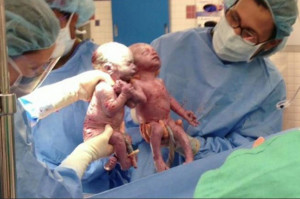 Parents Of Twins Born Holding Hands Describe Experience: 'My Heart ...