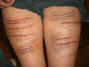 how to get rid of scars from cutting