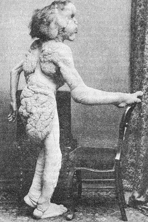 photograph of Joseph Merrick, known as the 