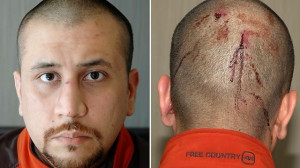 Prosecution witness: Zimmerman's injuries 'insignificant'