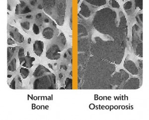 osteoporosis Images and Graphics