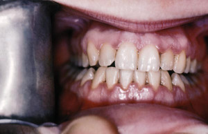 ... , these conditions can result in gum damage and loss of teeth