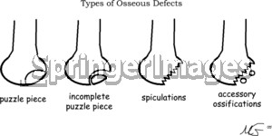... incomplete puzzle piece refers to incomplete or no ossification