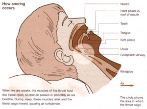 Remedies for Snoring